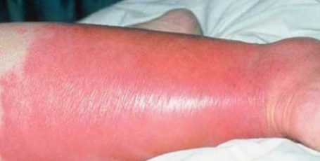 Рожистое воспаление кожи: симптомы, причины, это