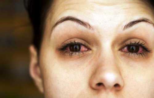 Воспаление века глаза: симптомы, причины, это