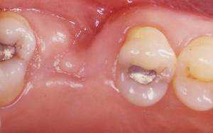 При сильном иммунитете следует насторожиться даже при наличии одной язвочки в полости рта